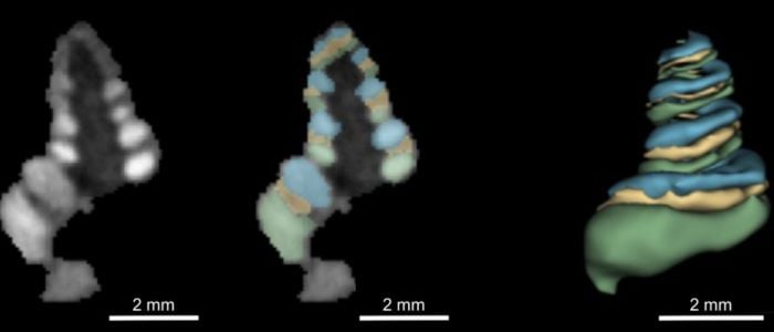 The first 3D printed microneedle to treat hearing loss